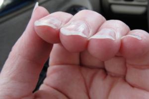 Неровные (волнистые) ногти, причины, лечение